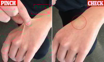 dehydration the pinch test